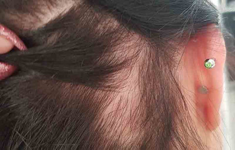 Gambar Alopecia Areata, Gangguan Autoimun yang Menyebabkan Rambut Rontok