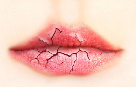 Gambar Bibir Pecah-Pecah Selama Bulan Puasa? Ini Solusinya!