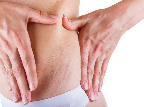 Gambar Cara Menghilangkan Stretch Mark Pasca Melahirkan