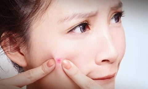 Gambar Mengapa Jerawat Selalu Timbul di Tempat Yang Sama?