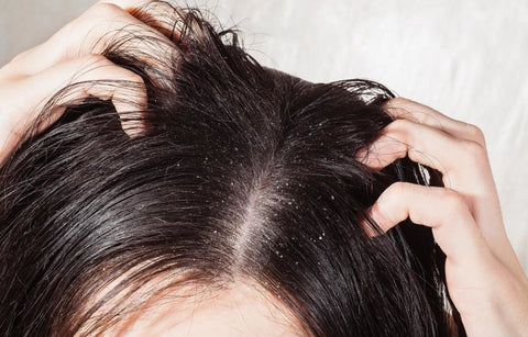 Gambar Rambut Berketombe? Singkirkan dengan 7 Makanan Ini!