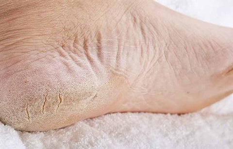 Gambar 4 Krim Paling Bagus untuk Mengatasi Kulit Kaki Pecah dan Kering