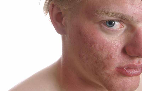 Gambar 5 Jenis Bekas Jerawat Ini Bisa Anda Atasi dengan Penanganan yang Tepat