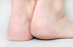 4 Cara Ampuh untuk Hilangkan Tumit Pecah-Pecah