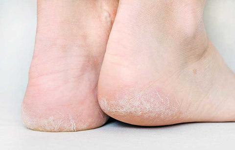 Gambar 4 Cara Ampuh untuk Hilangkan Tumit Pecah-Pecah