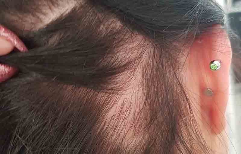 Alopecia Areata, Gangguan Autoimun yang Menyebabkan Rambut Rontok | FAVO