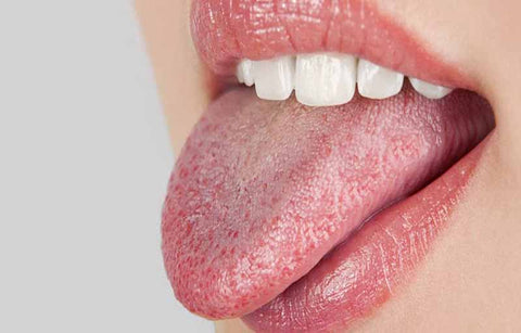 Gambar Atasi Mulut Kering Dengan 10 Langkah Ini!