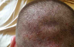 Cara Menangani dan Mencegah Jerawat Kulit Kepala ini Wajib Anda Simak!