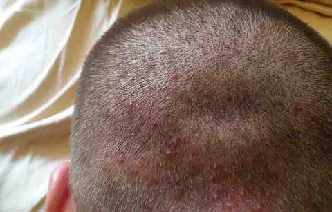 Gambar Cara Menangani dan Mencegah Jerawat Kulit Kepala ini Wajib Anda Simak!