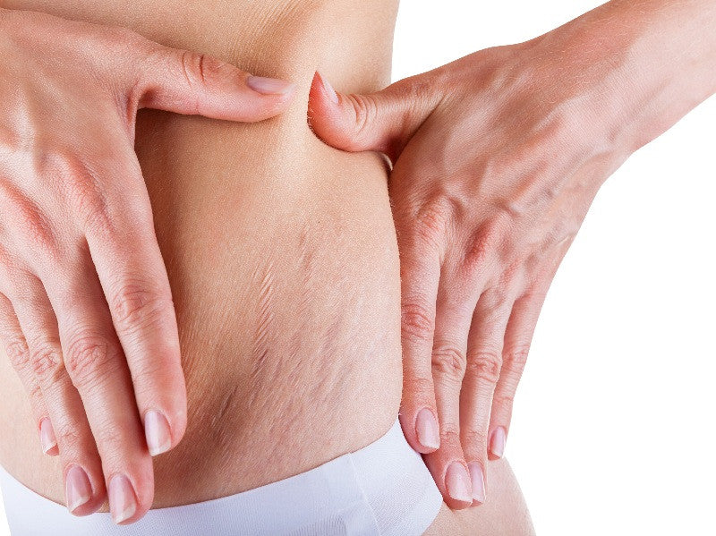 Cara Menghilangkan Stretch Mark Pasca Melahirkan