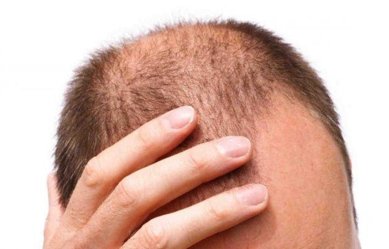 Cegah Kebotakan dengan 6 Jenis Bahan Pangan Ini