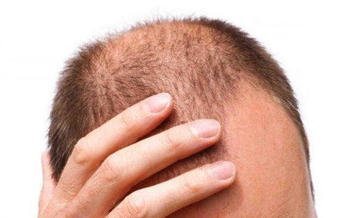 Gambar Cegah Kebotakan dengan 6 Jenis Makanan Ini