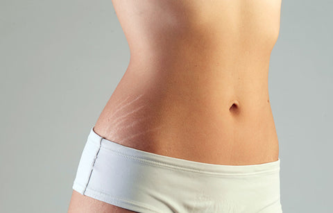 Gambar Fakta-Fakta Strech Marks yang Harus Anda Tahu!