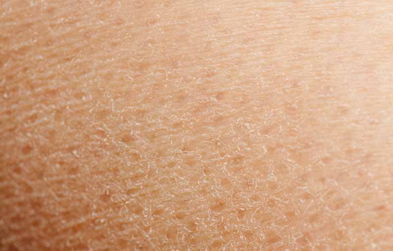 Hati-Hati Ladies, 4 Kebiasaan Ini Bisa Membuat Kulit Kering!