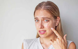 Hati-hati, Cara-cara Ini Hanya Akan Memperparah Jerawat Anda!