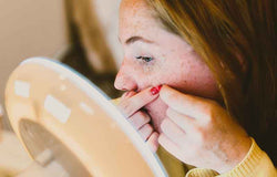 Jangan Sampai Salah Perawatan, Kenali Dulu Jenis-jenis Jerawat Ini!