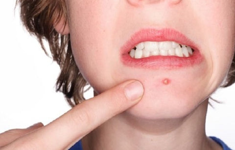 Gambar Jenis Jerawat dan Cara Mengatasinya