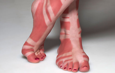 Gambar Kulit Belang Terbakar Matahari Kapan Pulihnya, Ya?