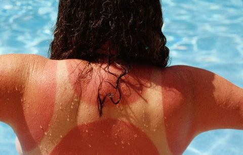 Gambar Kulit Terbakar? Ini 5 Cara Mengatasinya