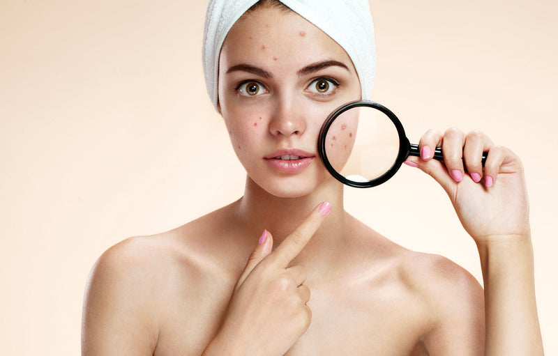 Ladies, Ini Perbedaan Cold Sores dan Jerawat