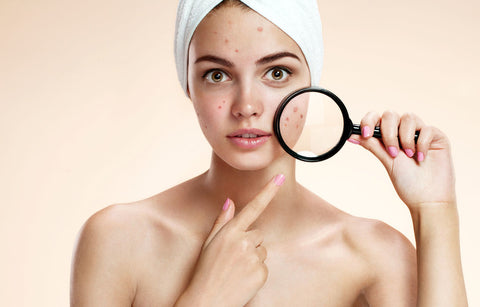 Gambar Ladies, Ini Perbedaan Cold Sores dan Jerawat