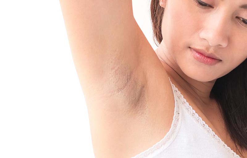 Ucapkan Selamat Tinggal Kepada Ketiak Hitam Dengan 5 Cara Alami Ini!