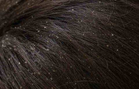 Gambar Waduh, Berhati-hatilah Dengan 5 Makanan Penyebab Ketombe Ini!