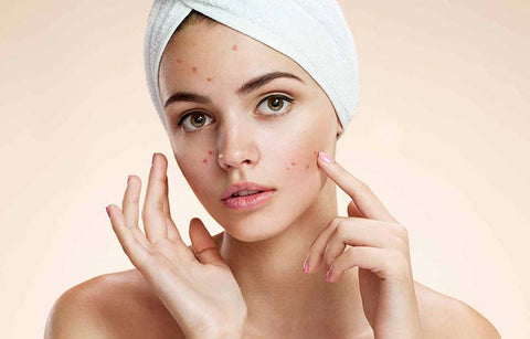 Gambar Inilah 4 Cara Menghilangkan Jerawat Secara Alami Hanya Dalam Semalam!