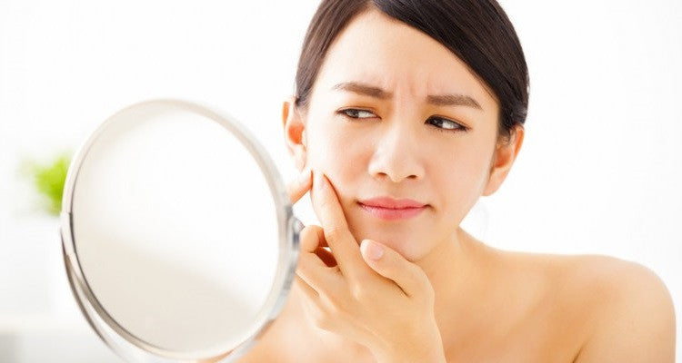 7 Cara Mengatasi Jerawat Hormon Saat Menstruasi