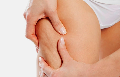 Gambar 7 Fakta Tentang Selulit yang Harus Anda Tahu!