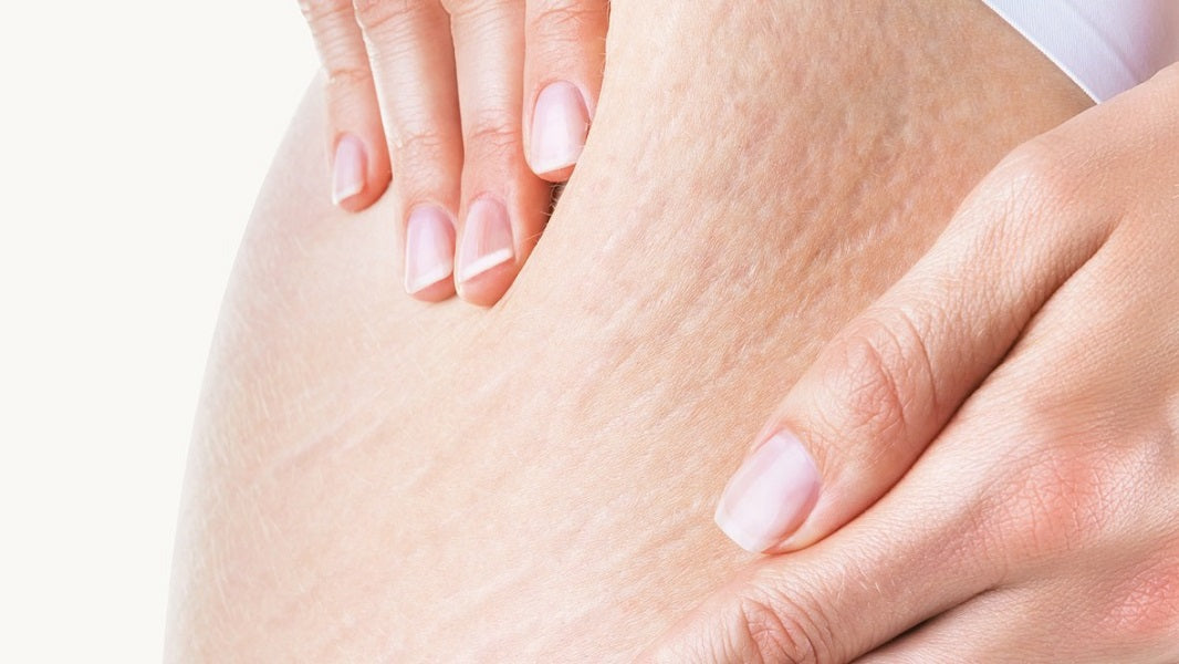 Dermaoil vs Bio Oil, Penghilang Stretch Mark Mana yang Terbaik?